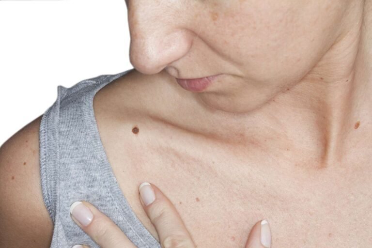 What is a Skin Mole and What Are the Main Characteristics of This Skin Growth?