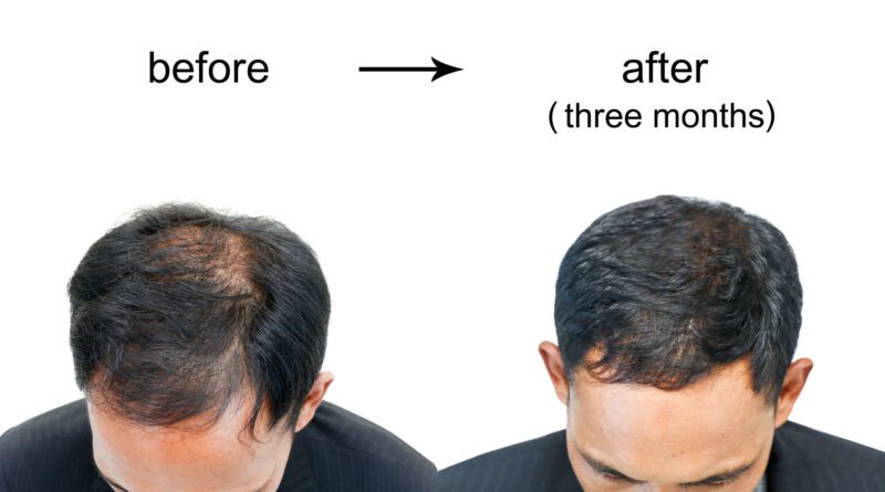 Reduce Hair Loss in Men