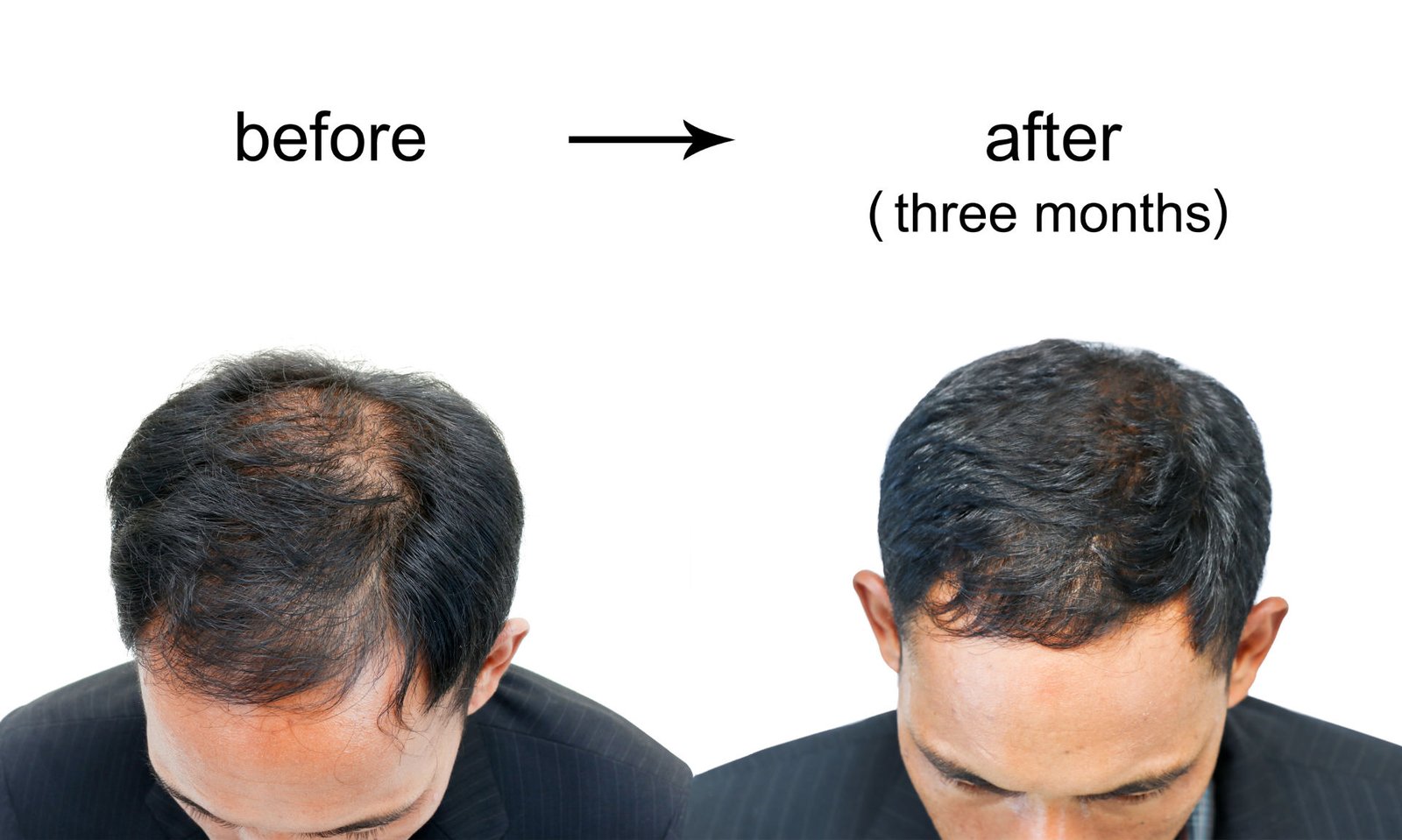 Reduce Hair Loss in Men