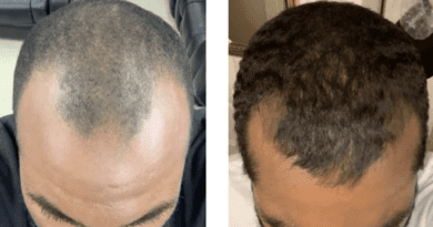 Minoxidil for Male Hair Loss Problems