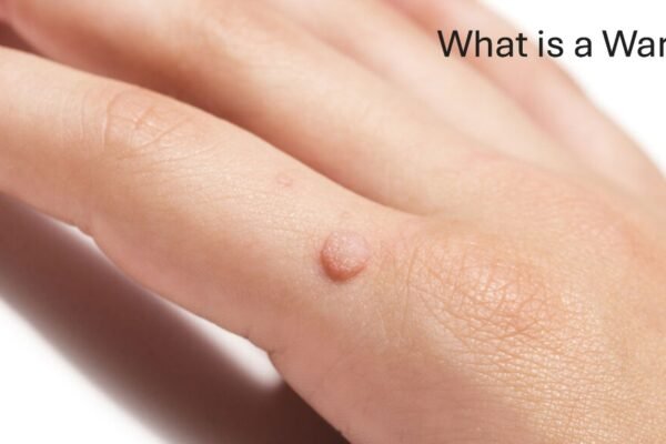 What is a Wart