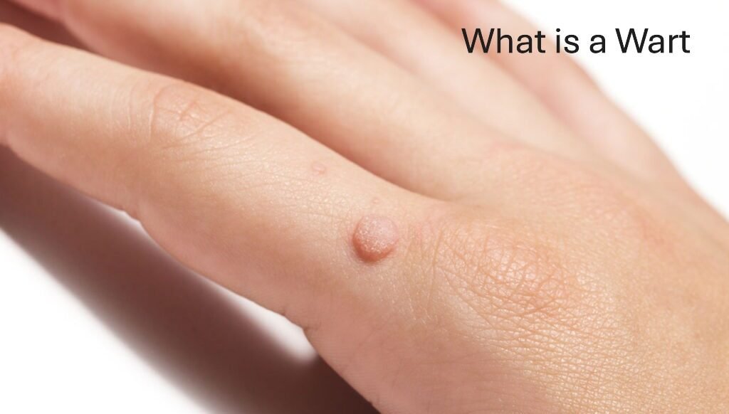 What is a Wart